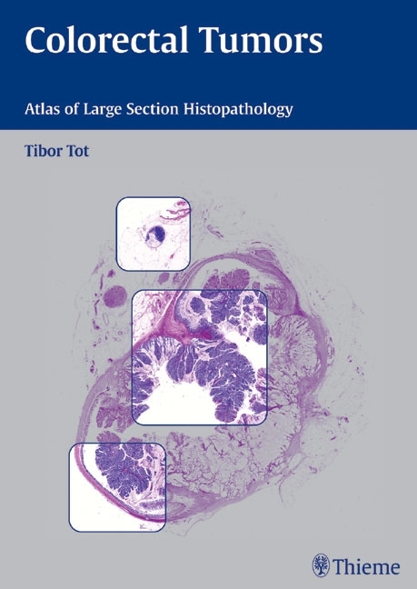 Colorectal Tumors - Tibor Tot