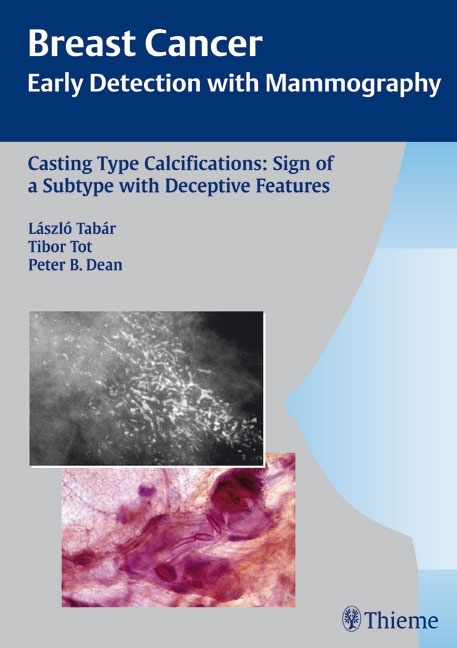Casting-Type Calcifications: Sign of a Subtype with Deceptive Features - Laszlo Tabar, Tibor Tot, Peter B. Dean