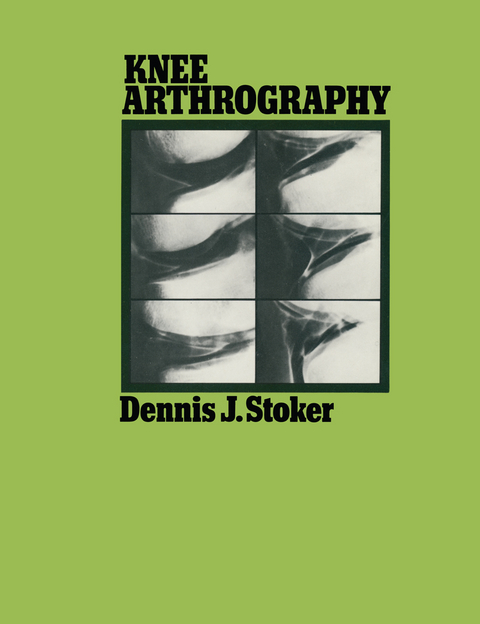 Knee Arthrography - Dennis J. Stoker