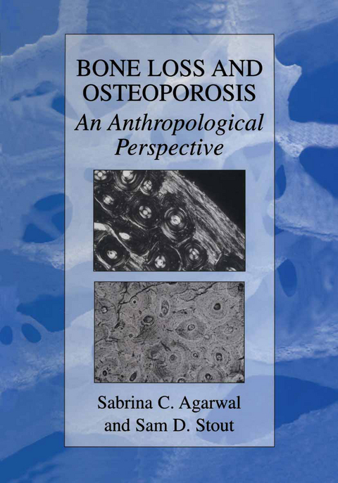 Bone Loss and Osteoporosis - 