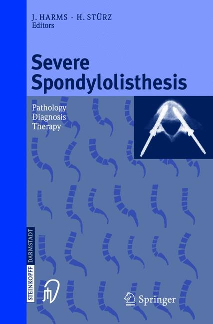 Severe Spondylolisthesis - 