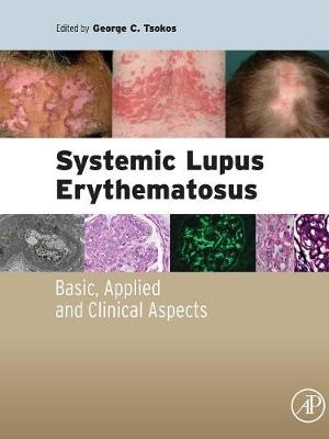 Systemic Lupus Erythematosus - 