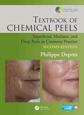 Textbook of Chemical Peels - Philippe Deprez