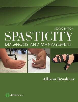 Spasticity - 