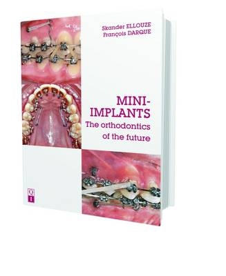Mini-Implants - Skander Ellouze, Francois Darque