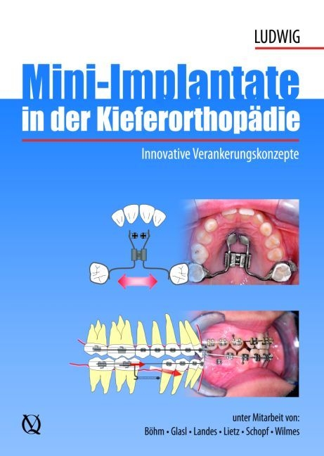 Mini-Implantate in der Kieferorthopädie - Björn Ludwig