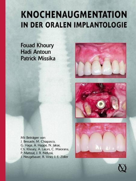Augmentive Verfahren in der oralen Implantogie - Fouad Khoury