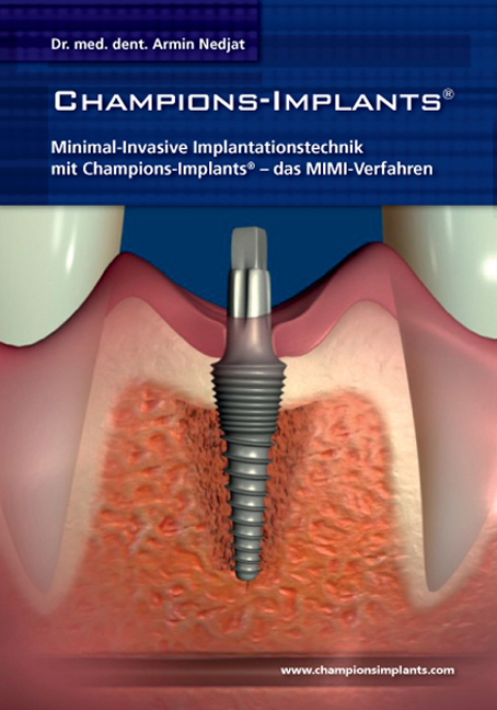 Minimal-invasive Methodik der Implantation (MIMI) in Sofortbelastung mit Champions-Implantaten - Andreas Reil
