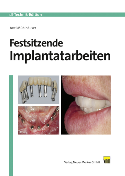 Festsitzende Implantatarbeiten - Axel Mühlhäuser