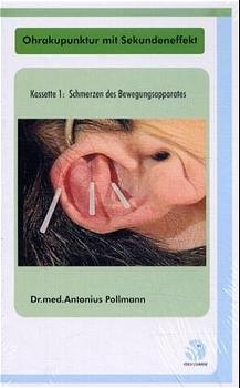 Ohrakupunktur mit Sekundeneffekt - Antonius Pollmann