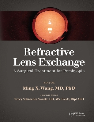 Refractive Lens Exchange - Ming Wang