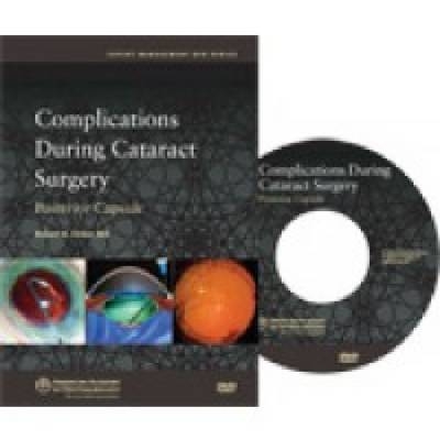 Complications During Cataract Surgery - 