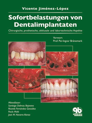 Sofortbelastung von Dentalimplantaten - Vicente Jiménez-López