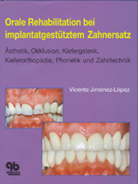 Orale Rehabilitation bei implantatgestütztem Zahnersatz - Vicente Jiménez-López