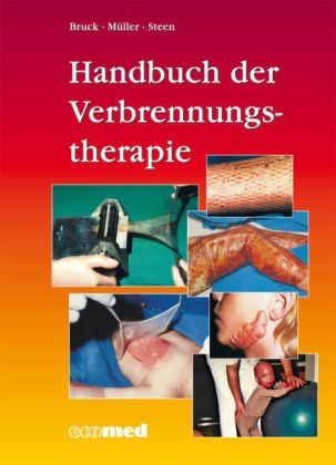 Handbuch der Verbrennungstherapie - Johannes C. Bruck, Fritz E. Müller, Michael Steen