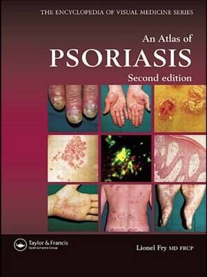 An Atlas of Psoriasis - Lionel Fry