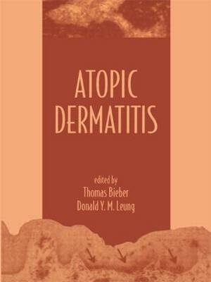 Atopic Dermatitis - 