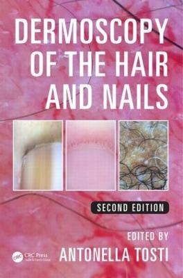 Dermoscopy of the Hair and Nails - Antonella Tosti