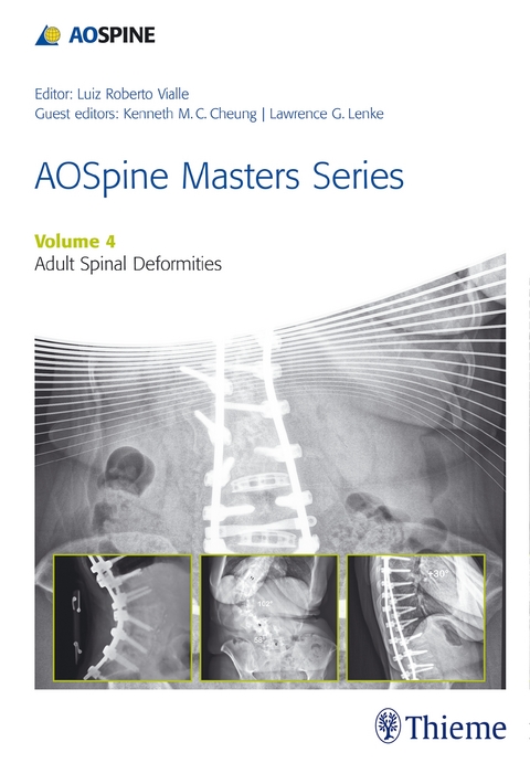 AOSpine Master Series, Vol. 4: Adult Spinal Deformities - 