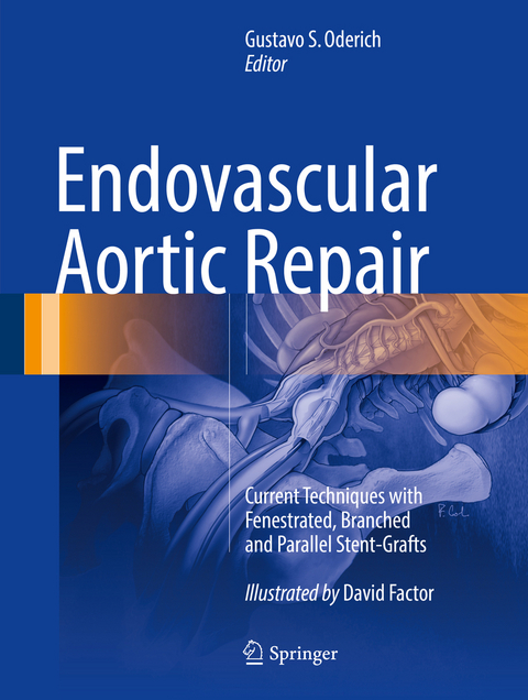 Endovascular Aortic Repair - 