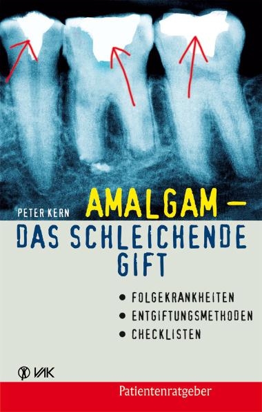 Amalgam - das schleichende Gift - Peter Kern