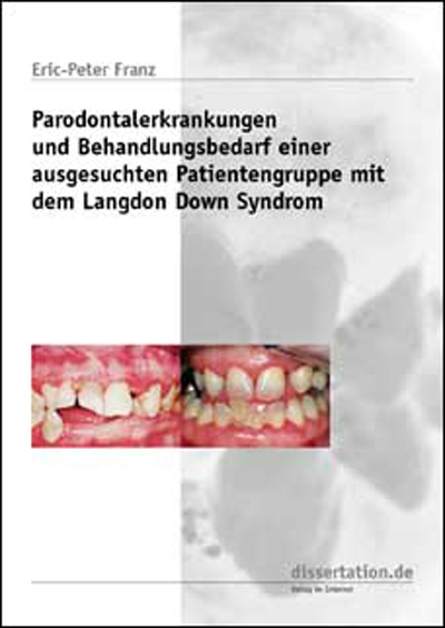Parodontalerkrankungen und Behandlungsbedarf einer ausgesuchten Patientengruppe mit dem Langdon Down Syndrom - Eric P Franz