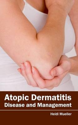 Atopic Dermatitis: Disease and Management - 