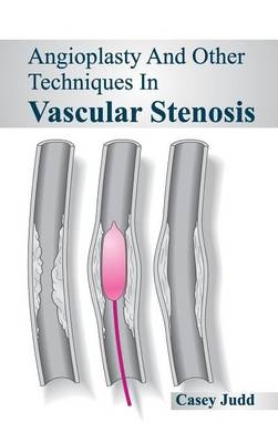 Angioplasty and Other Techniques in Vascular Stenosis - 