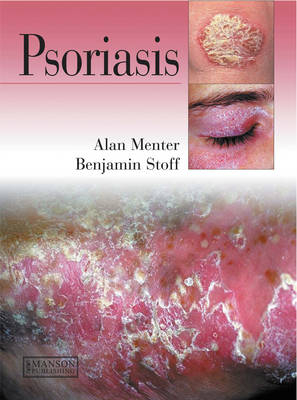 Psoriasis - Alan Menter, Benjamin Stoff