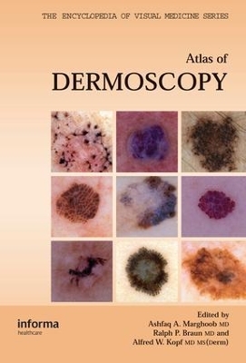 An Atlas of Dermoscopy - 