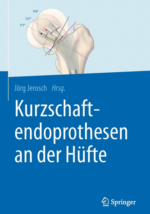 Kurzschaftendoprothesen an der Hüfte - 