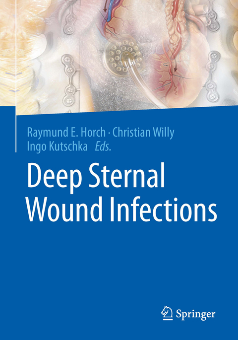 Deep Sternal Wound Infections - 