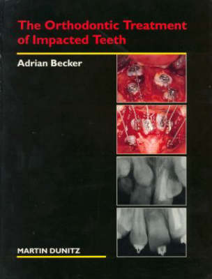 The Orthodontic Treatment of Impacted Teeth - Adrian Becker