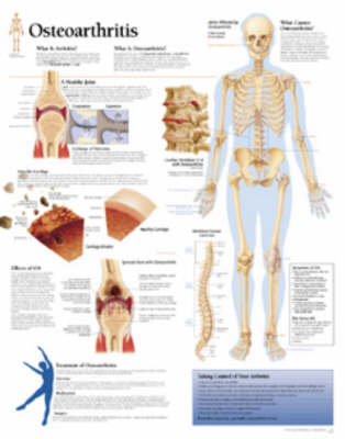 Osteoarthritis Laminated Poster -  Scientific Publishing