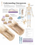 Understanding Osteoporosis Paper Poster -  Scientific Publishing