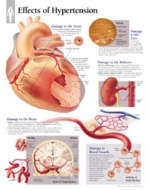 Effects of Hypertension Paper Poster -  Scientific Publishing