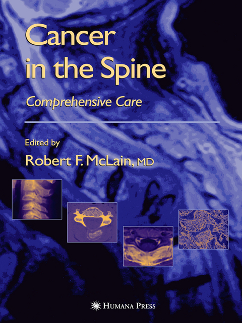 Cancer in the Spine - 
