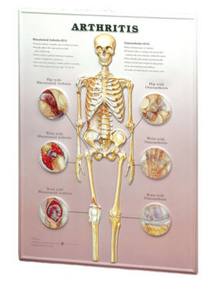 Arthritis: 3D Lenticular Chart