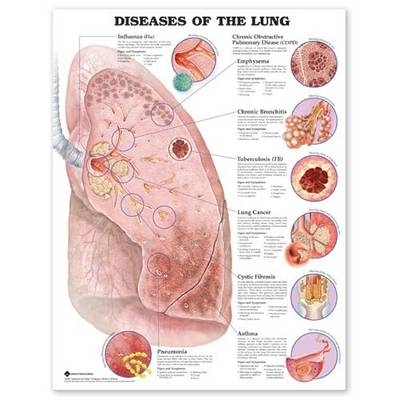 Diseases of the Lung Anatomical Chart