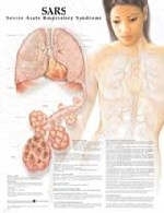 SARS: Severe Acute Respiratory Syndrome Anatomical Chart -  Anatomical Chart Company