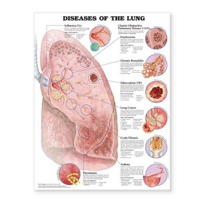 Diseases of the Lung Anatomical Chart