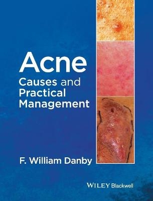 Acne - F. William Danby