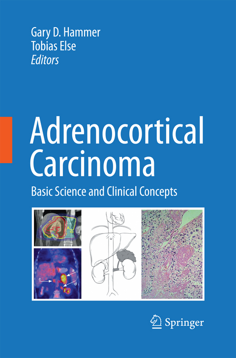 Adrenocortical Carcinoma - 