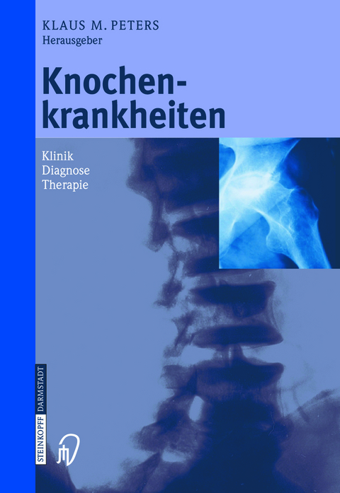 Knochenkrankheiten - 