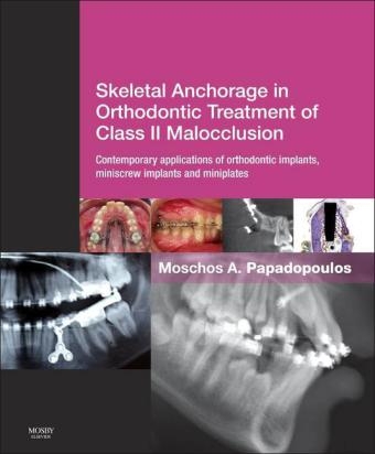 Skeletal Anchorage in Orthodontic Treatment of Class II Malocclusion - 