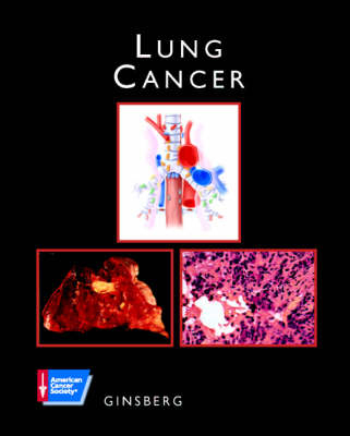 Lung Cancer - Robert J. Ginsberg