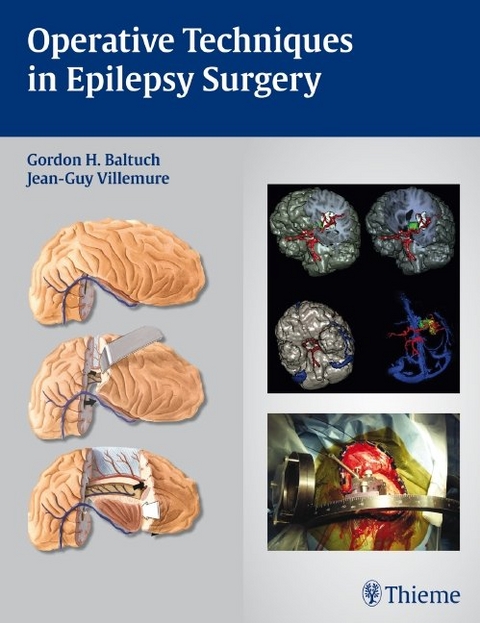 Operative Techniques in Epilepsy Surgery - 