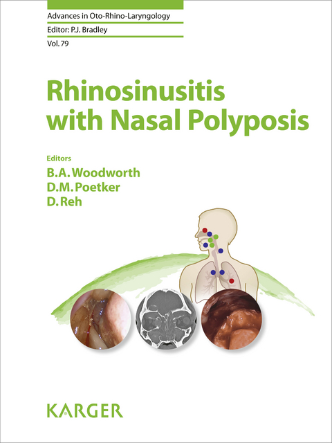 Rhinosinusitis with Nasal Polyposis - 
