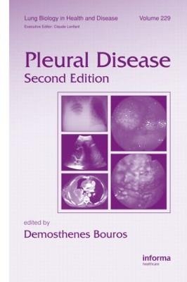 Pleural Disease - 