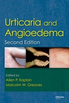 Urticaria and Angioedema - Allen Kaplan, Malcolm Greaves